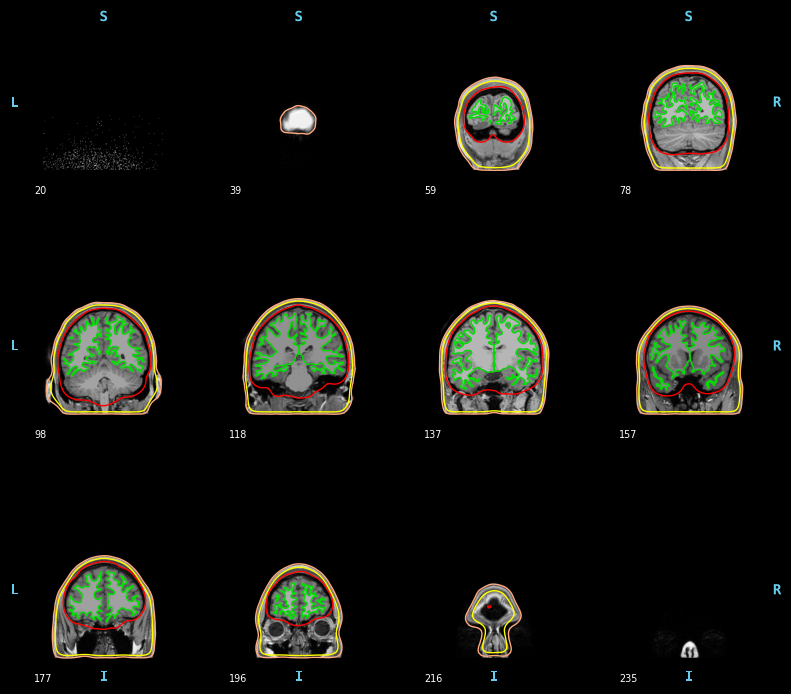 ../../../_images/6-meg-pipeline-gallery_notebooks_mne_mne_kit_computing_bem_model_16_2.png
