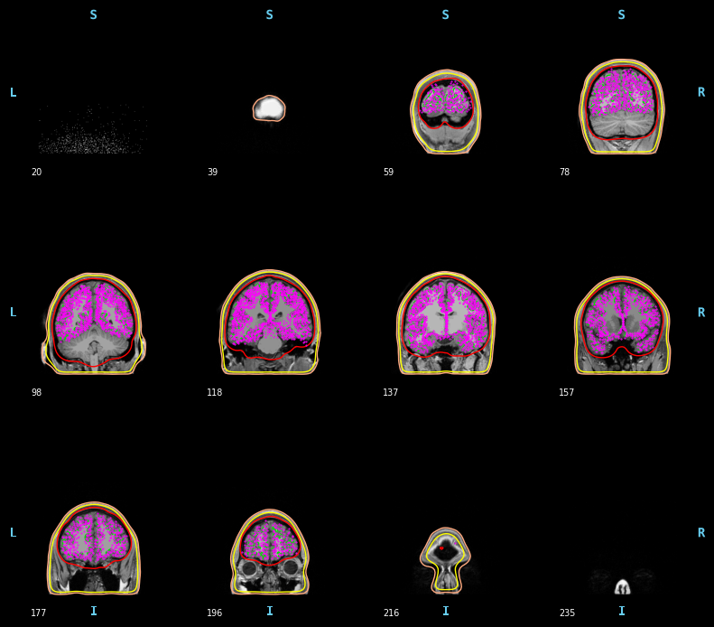 ../../../_images/6-meg-pipeline-gallery_notebooks_mne_mne_kit_computing_bem_model_20_2.png